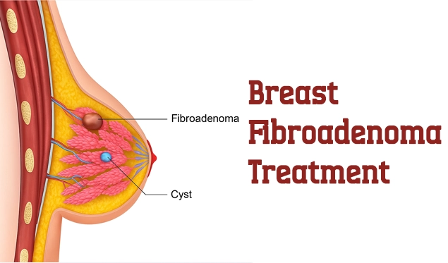 breast fibroadenoma treatment