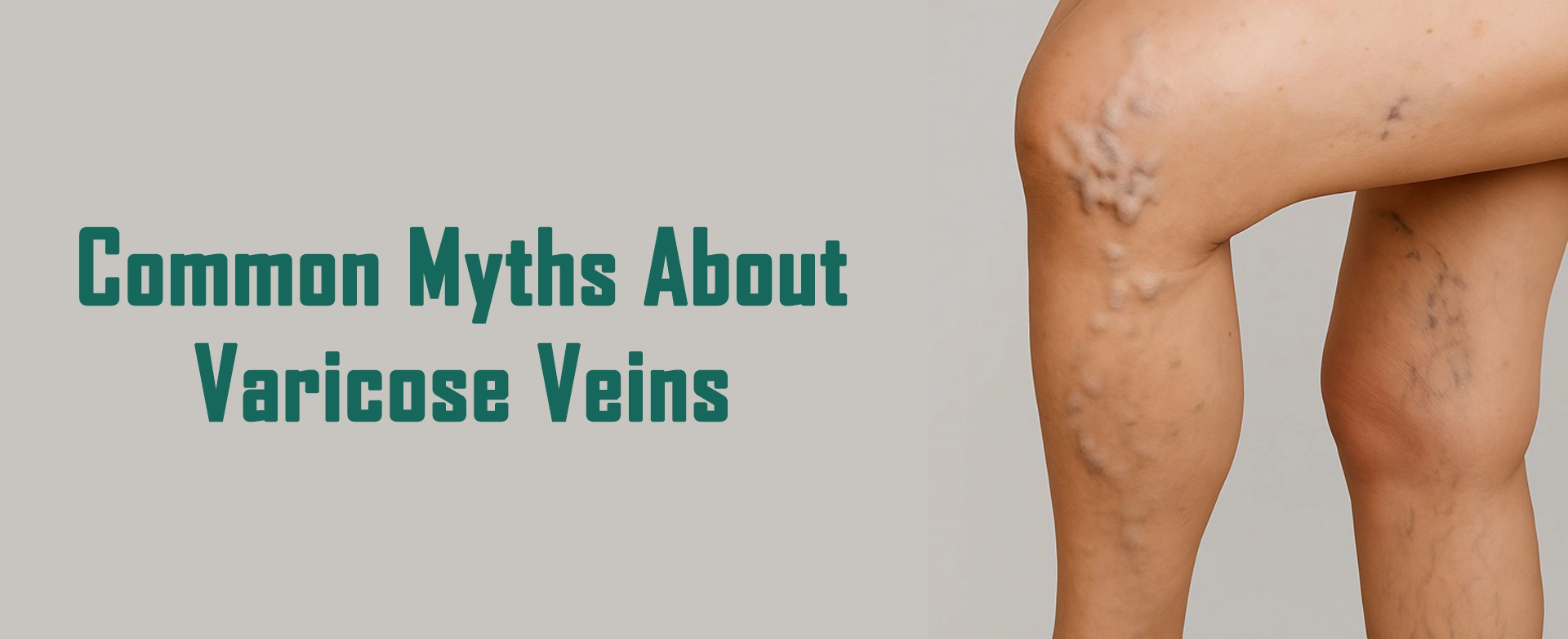 Common Myths About Varicose Veins