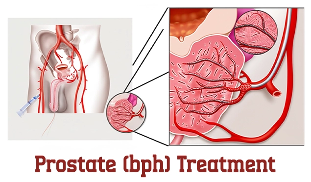 prostate bph treatment